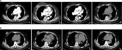 CT-guided iodine-125 brachytherapy as salvage therapy for local-regional recurrent breast cancer